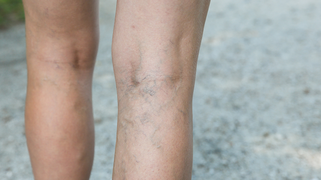 Using Compression Stockings for Deep Vein Thrombosis